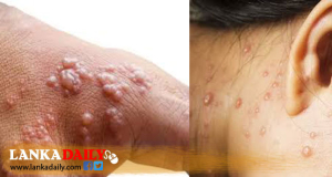 මිනුවන්ගොඩ ඇඟලුම් කම්හලේ 133 දෙනකුට පැපොල