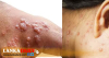 මිනුවන්ගොඩ ඇඟලුම් කම්හලේ 133 දෙනකුට පැපොල