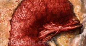 වකුගඩු රෝගයට හේතුව බාල පොහොර බව සනාත වේ